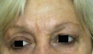 rides-creuses-yeux-avant-toxine-botulique