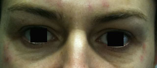 rides-pattes-d'oie-toxine-botulique-aprs