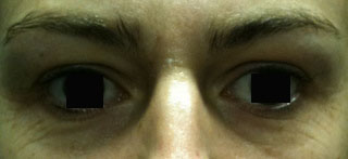 pattes-d-oie-avant-toxine-botulique-dr-midoz