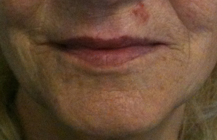 hliodermie-bouche-acide-hyaluronique-apres