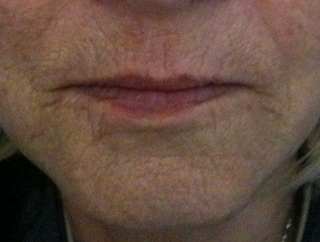 bouche-fine-ridules-hliodermie-avant