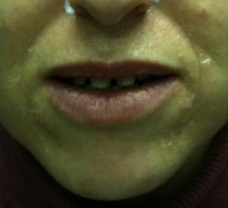 sillons-nasogniens-avant-acide-hyaluronique