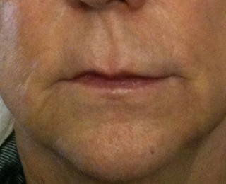 rides-creuses-bouche-aprs-acide-hyaluronique