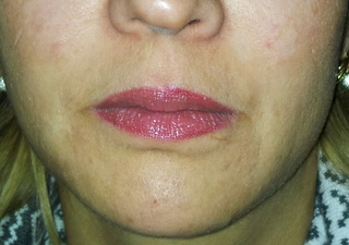 cupidon-lvres-acide-hyaluronique-avant