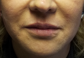 acide-hyaluronique-lvre-cupidon