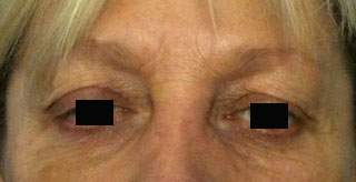 rides-creuses-aprs-toxine-botulique