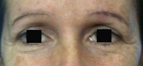 sourcils-tombants-avant-toxine-botulique