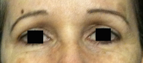 sourcils-tombants-aprs-toxine-botulique