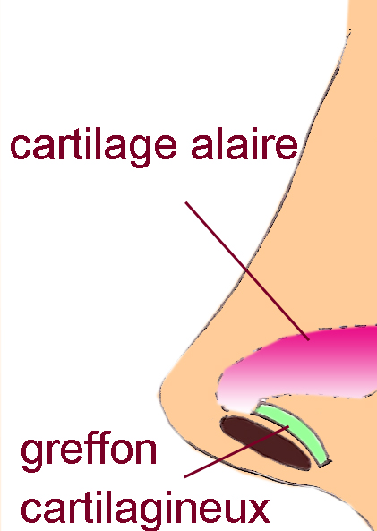 greffon-aile-narine-retractee-profil-chirurgie-esthetique-rhinoplastie
