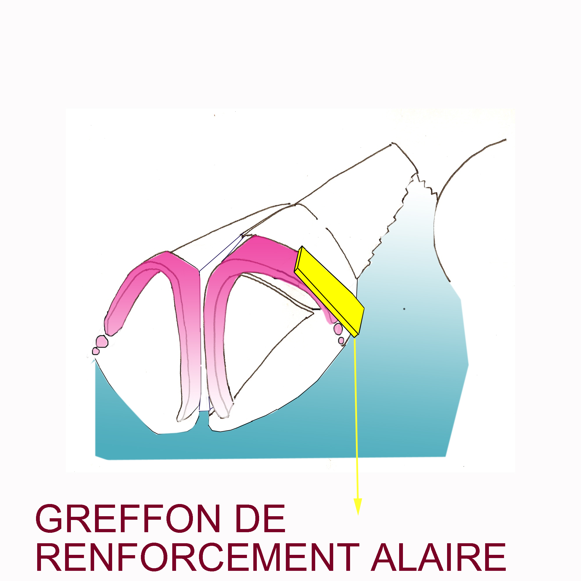 greffon-renforcement-valve-externe-chirurgie-esthetique