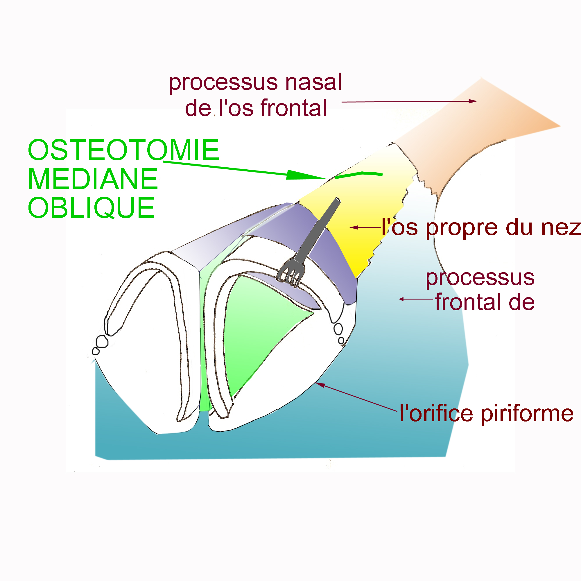 osteotomie-mediane-oblique-chirurgie-esthetique-rhinoplastie