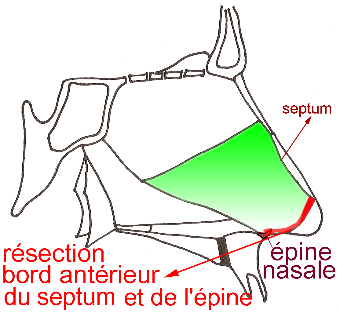resection-bord-septum-cloison-epine-nasale-chirurgie-esthetique-rhinoplastie