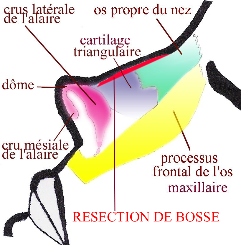 resection-bosse-nez-chirurgie-esthetique-rhinoplastie