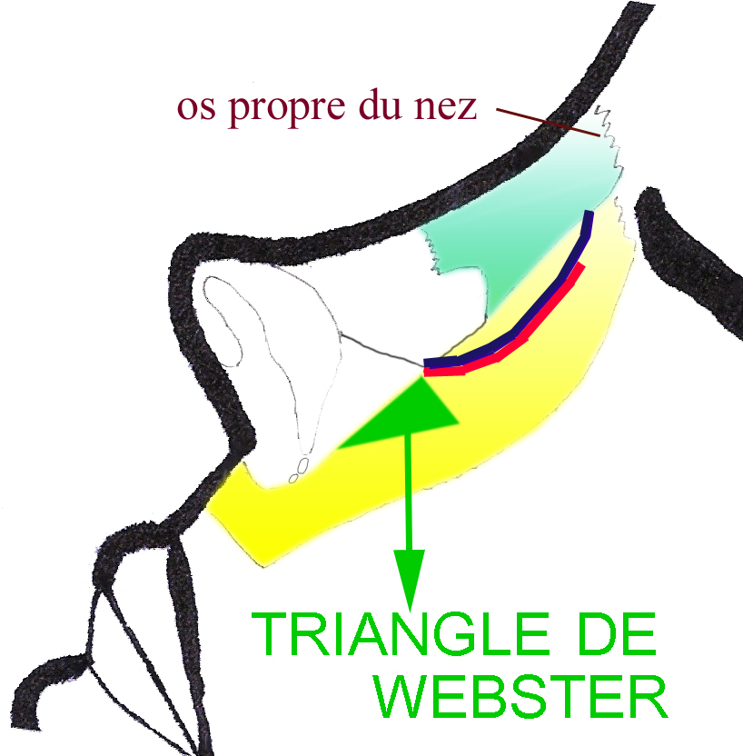 triangle-webster-chirurgie-esthetique-rhinoplastie