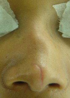 nez-fracture-bosse-dvi-avant