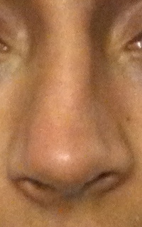 nez-dvi-bosse-rhinoplastie-avant