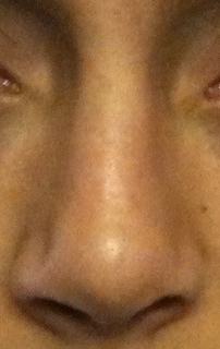 nez-dvi-bosse-rhinoplastie-aprs