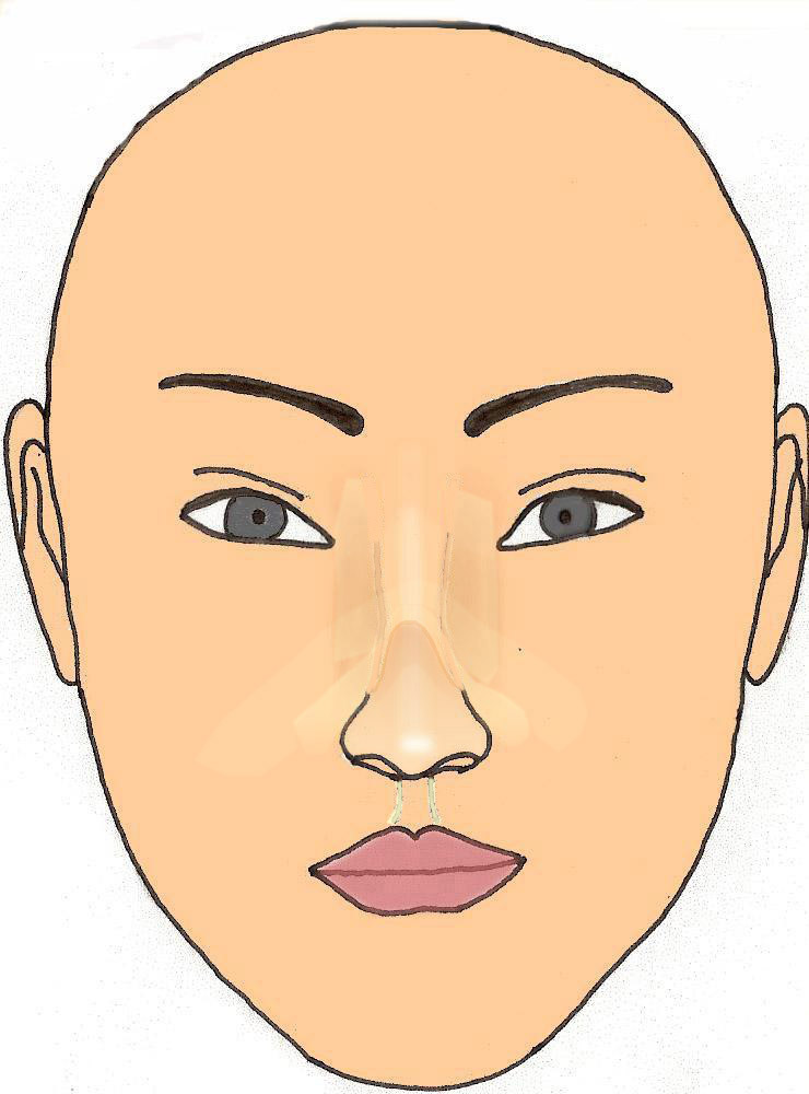 V-inverse-rhinoplastie-chirurgie-esthetique