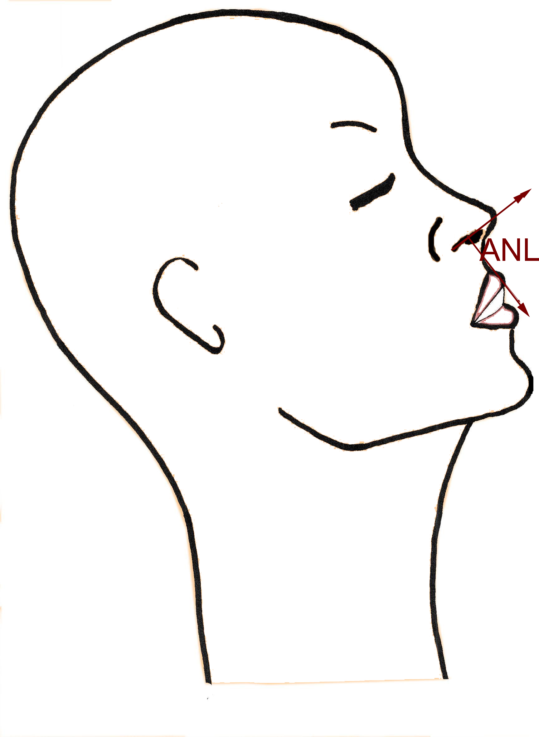 anglenasolabial-nez-grand-rhinoplastie-chirurgie-esthetique