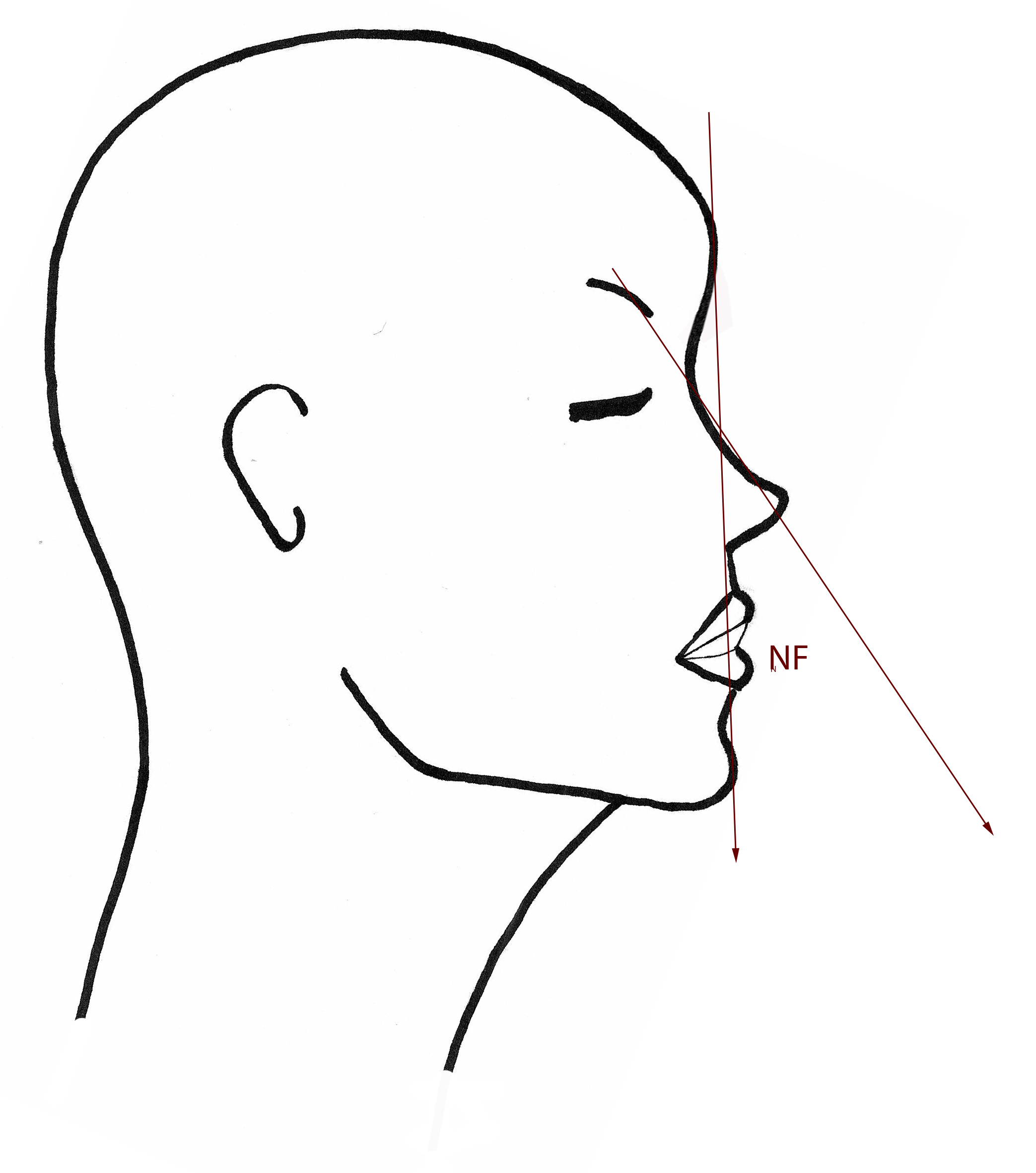 angleNF-grand-nez-rhinoplastie-chirurgie-esthetique