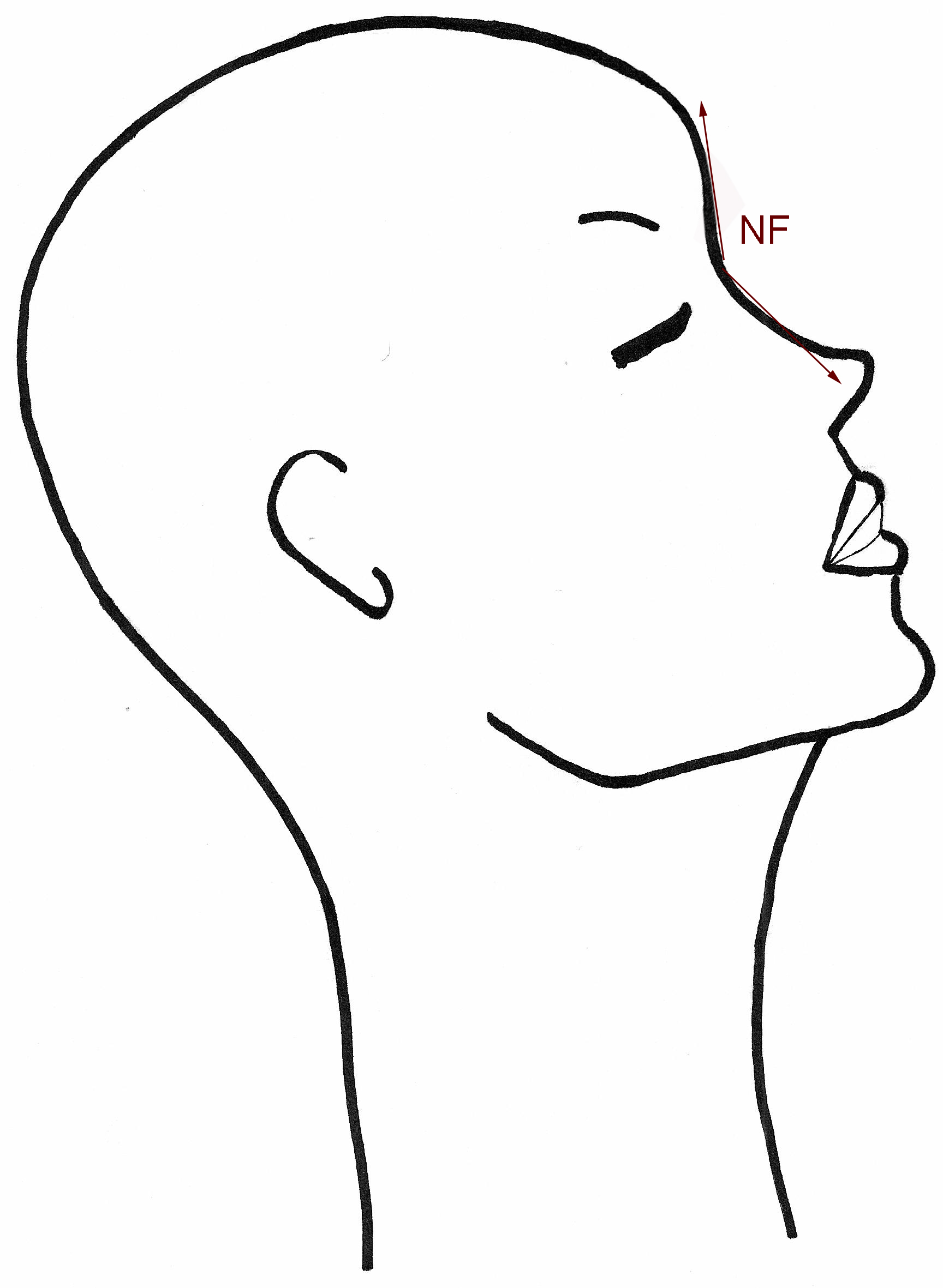 anglenasofrontal-grand-nez-chirurgie-esthetique-rhinoplastie