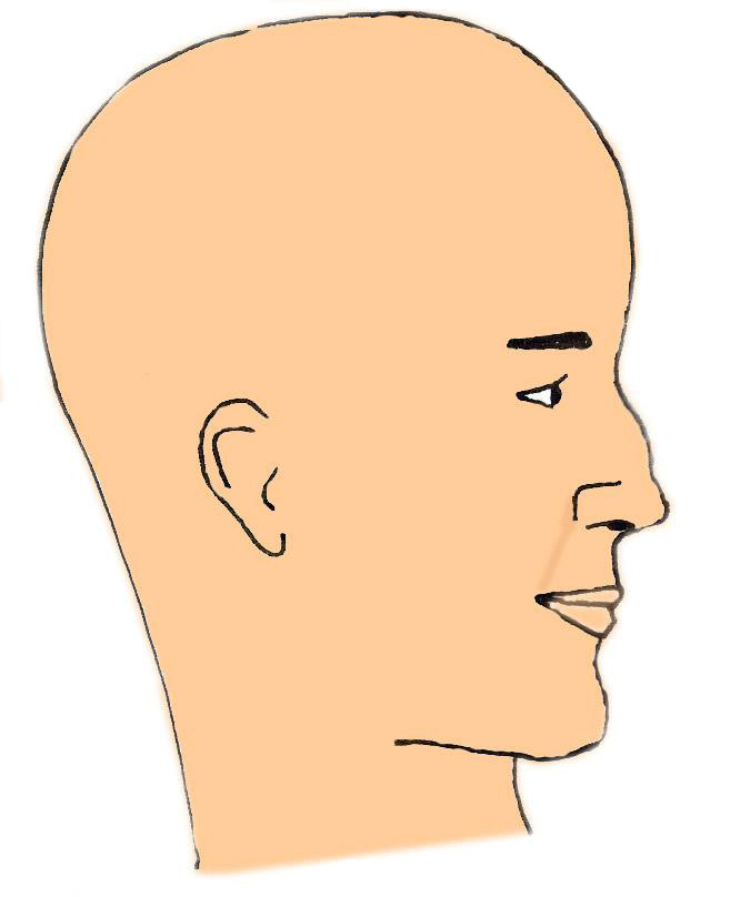 bosse-nez-dorsum-rhinoplastie-chirurgie-esthetique