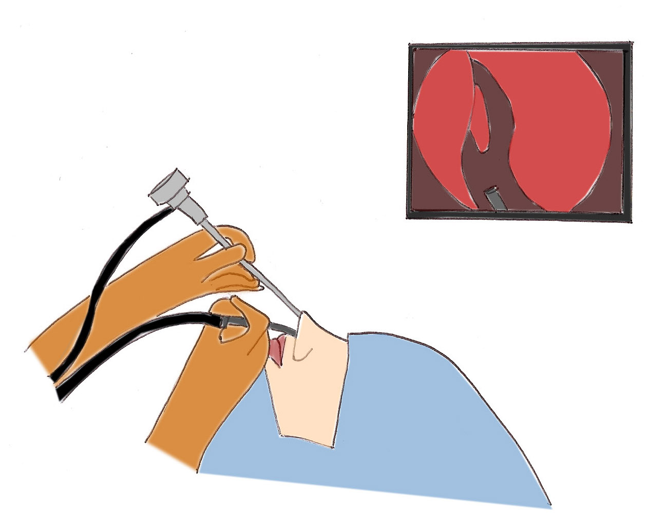 chirurgie-endonasale-obstruction-nasale-nez-bouche