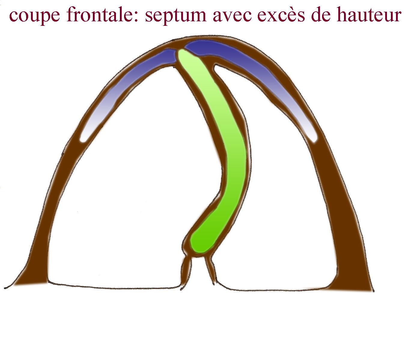 deviation-septum-cloison-nasale-chirurgie-esthetique-rhinoplastie