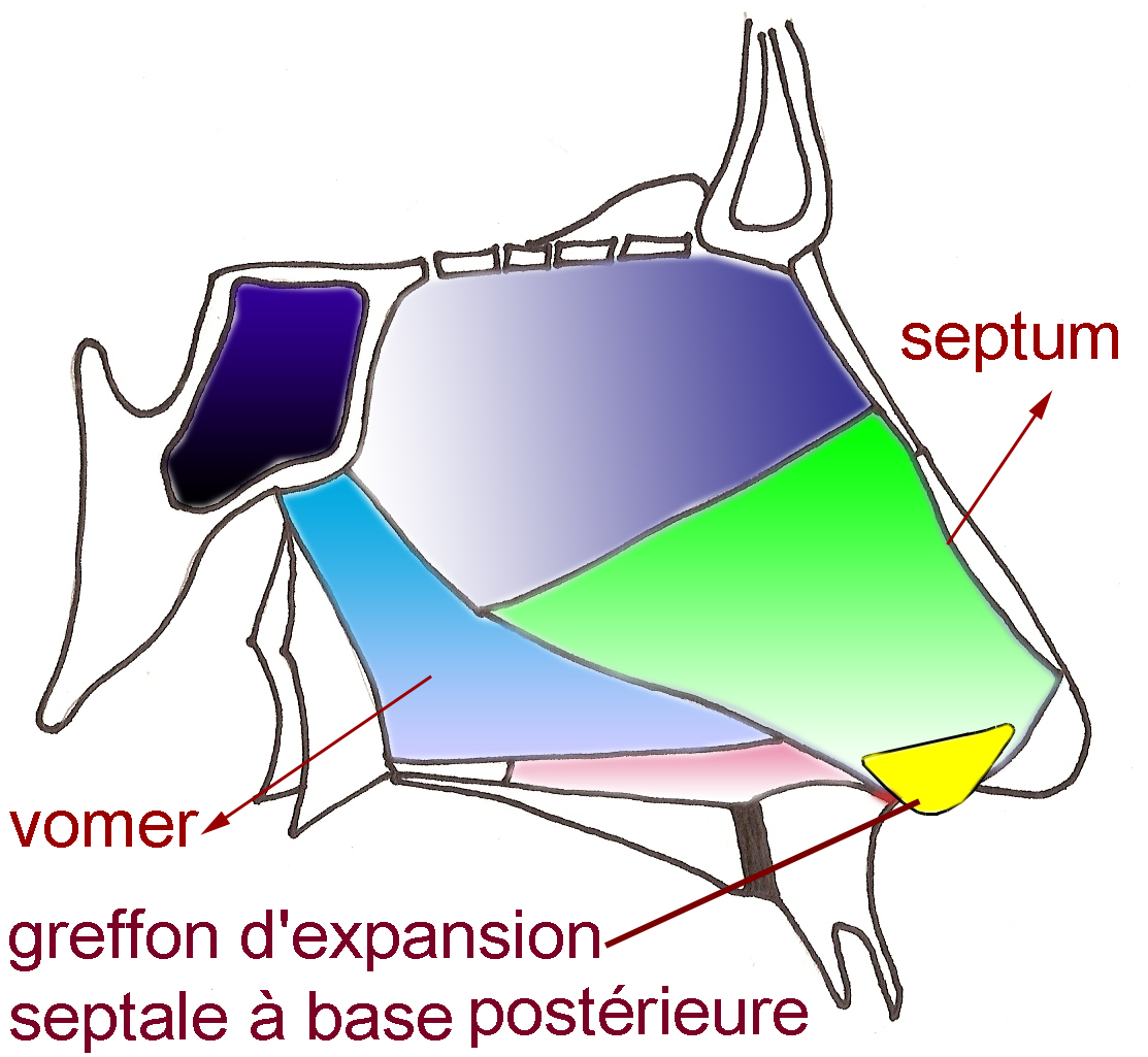 expansion-septale-ANLferme-chirurgie-esthetique-rhinoplastie
