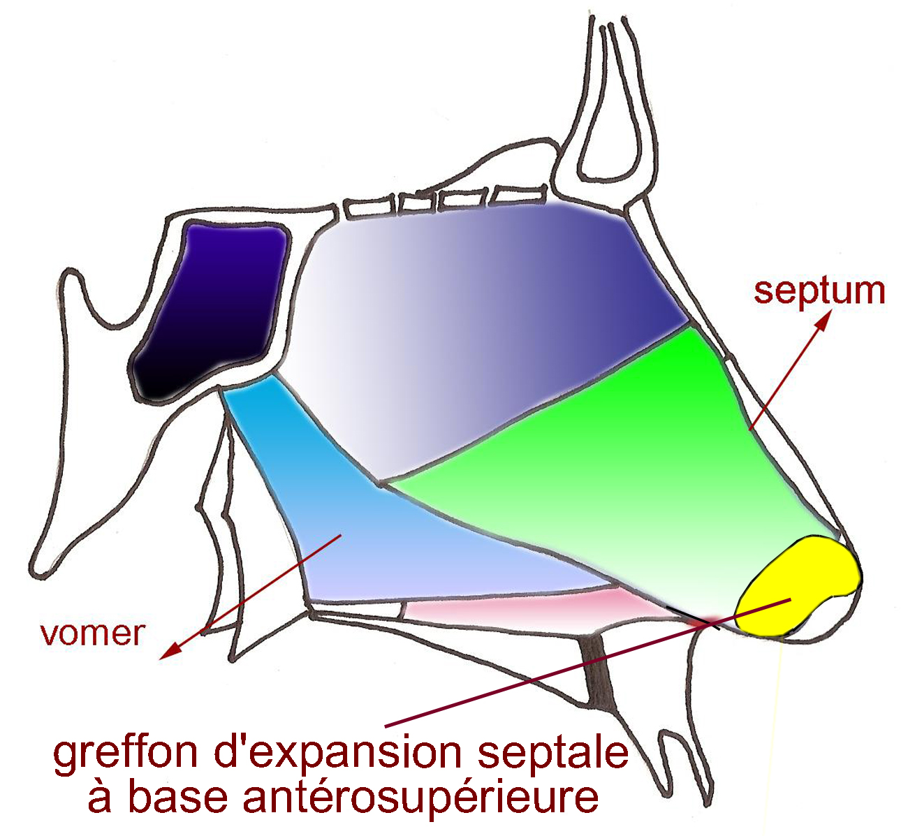expansion-septale-nez-petit-chirurgie-esthetique-rhinoplastie