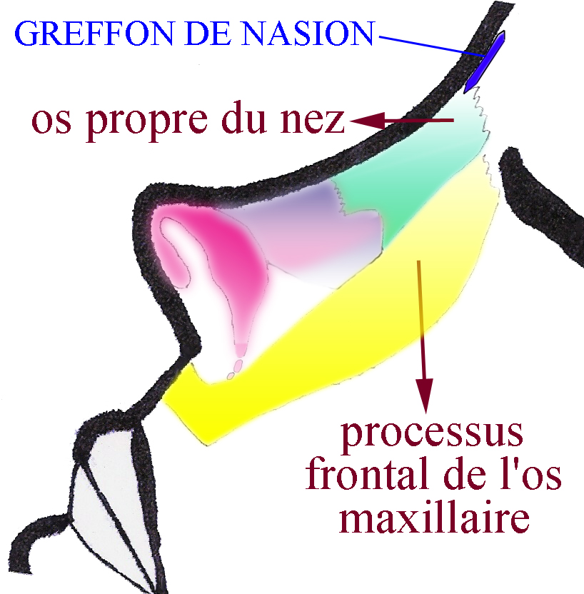 greffon-nasion-petit-nez-chirurgie-esthetique-rhinoplastie