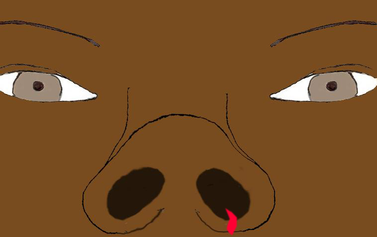 insertion-narines-larges-chirurgie-esthetique-rhinoplastie