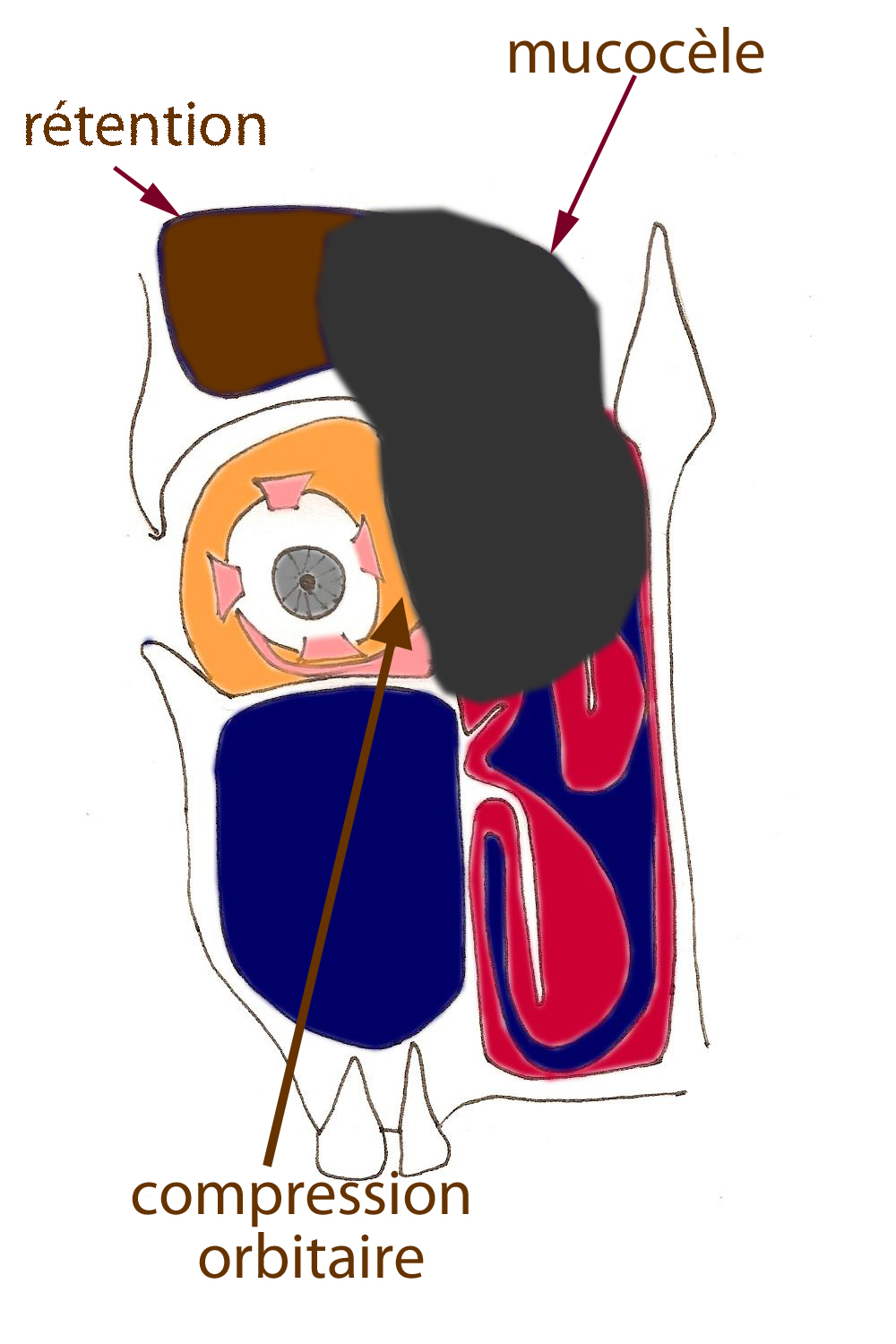 mucocele-sinus-obstruction-nasale-nez-bouche