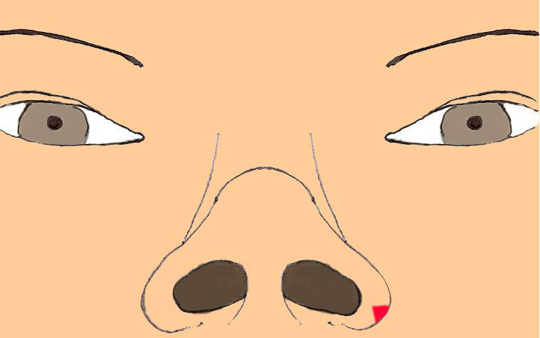 narine-elargie-resection-chirurgie-esthetique-rhinoplastie