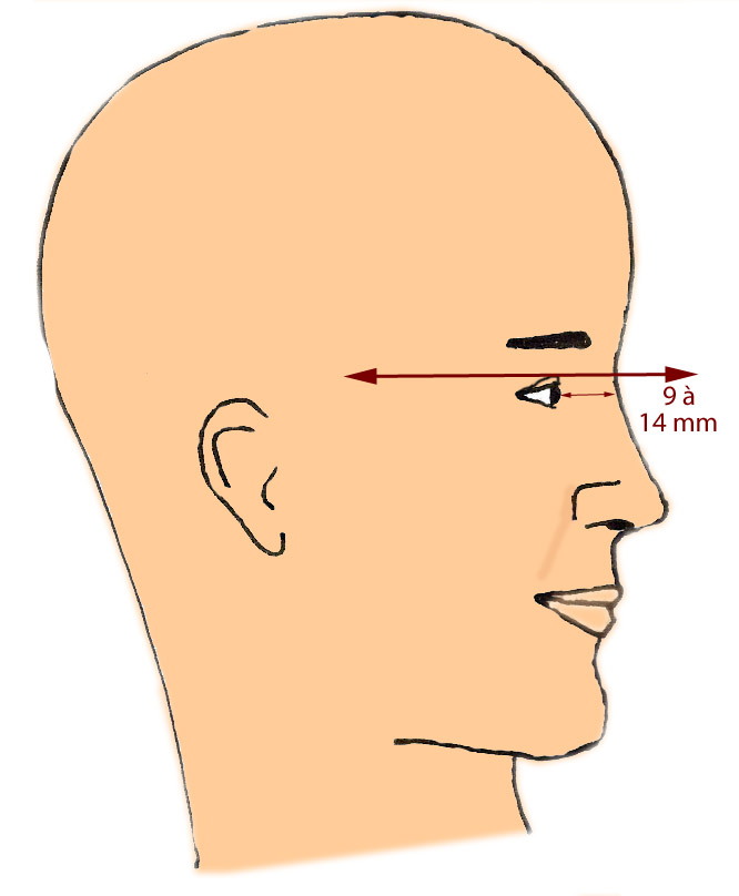 nasion-hauteur-rhinoplastie-chirurgie-esthetique