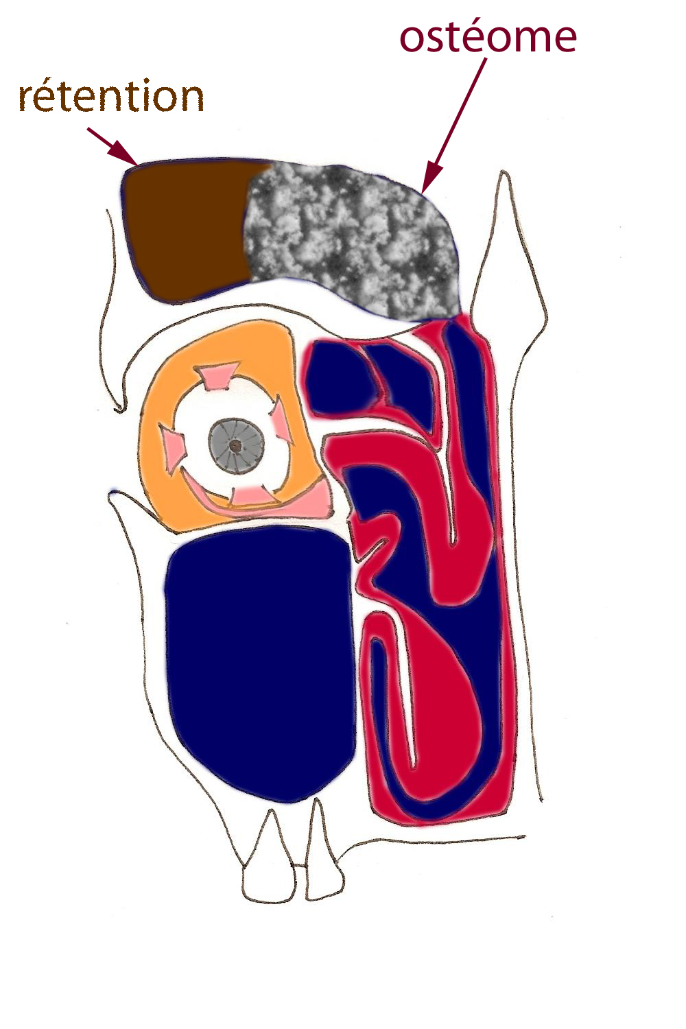 osteome-sinus-obstruction-nasale-nez-bouche