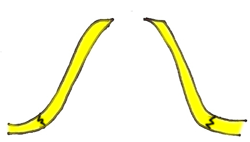 osteotomie-volets-gros-nez-chirurgie-esthetique-rhinoplastie