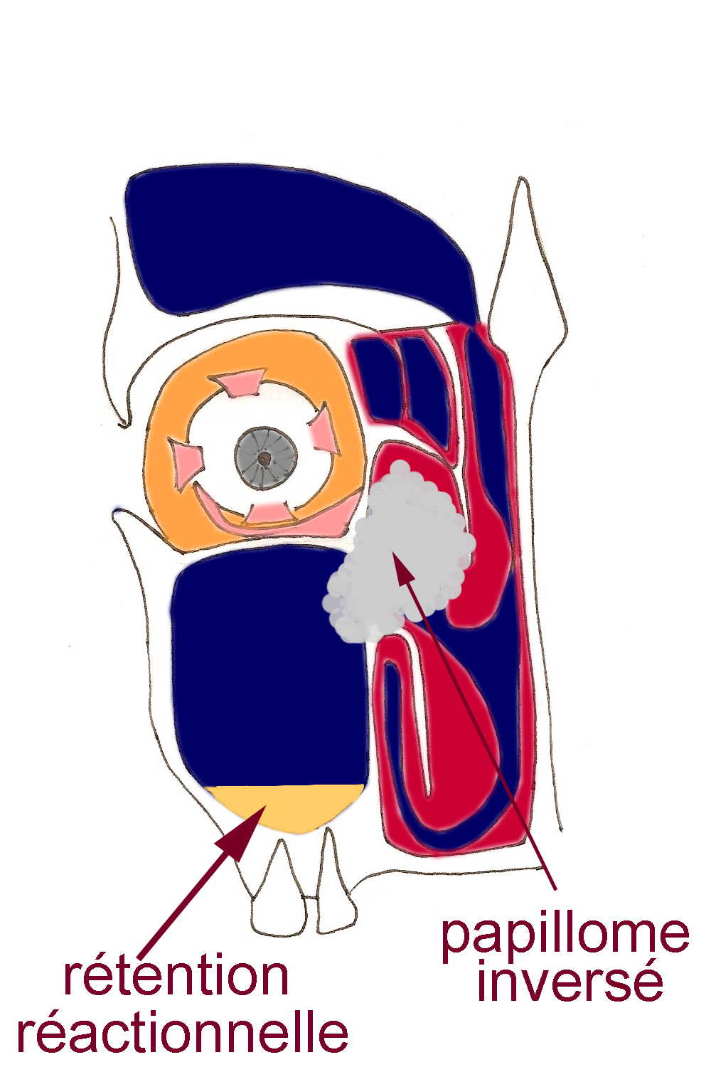 papillome-inverse-sinus-obstruction-nasale-rhinoplastie