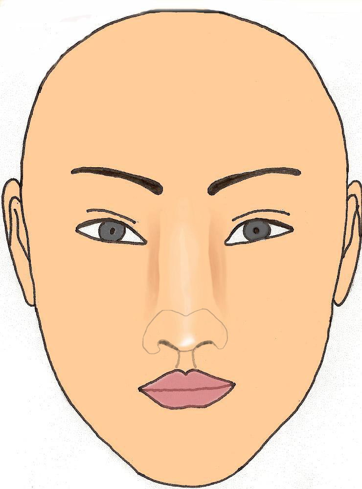 pointe-bifide-gros-nez-rhinoplastie-chirurgie-esthetique