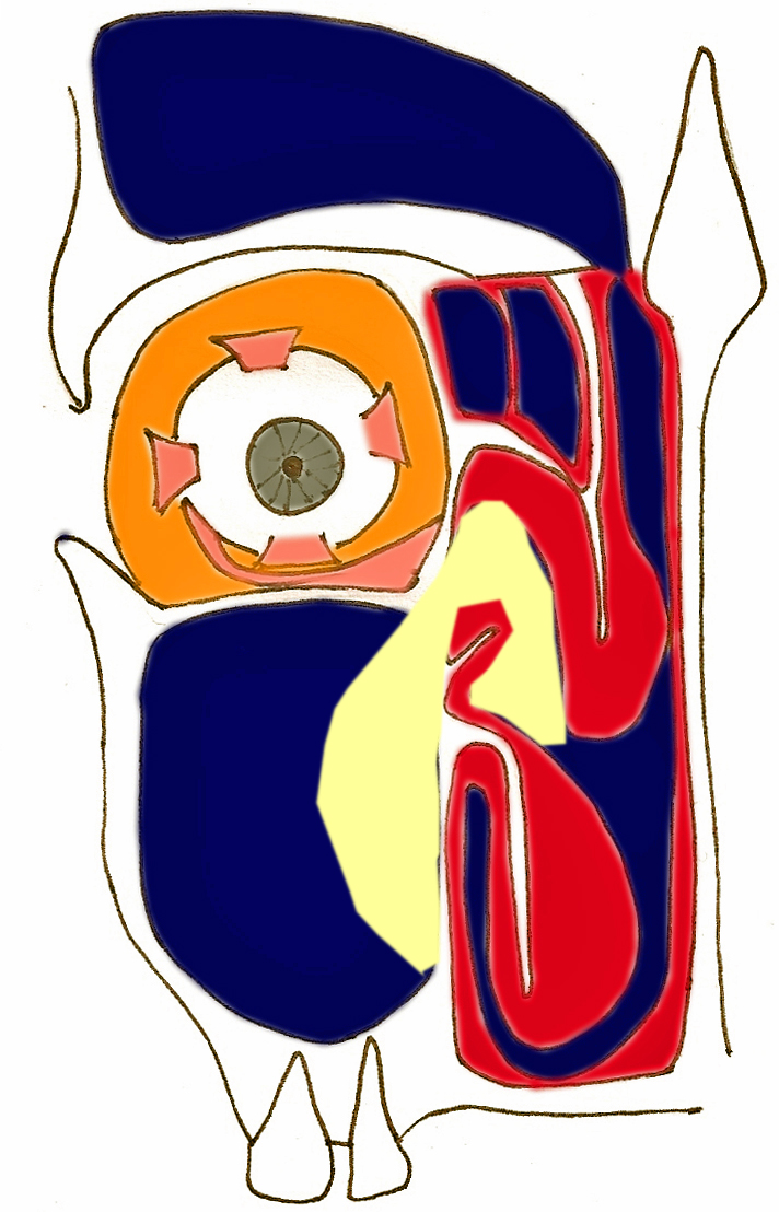 rhinosinusite-atrophique-sinus-infection-obstruction-nasale