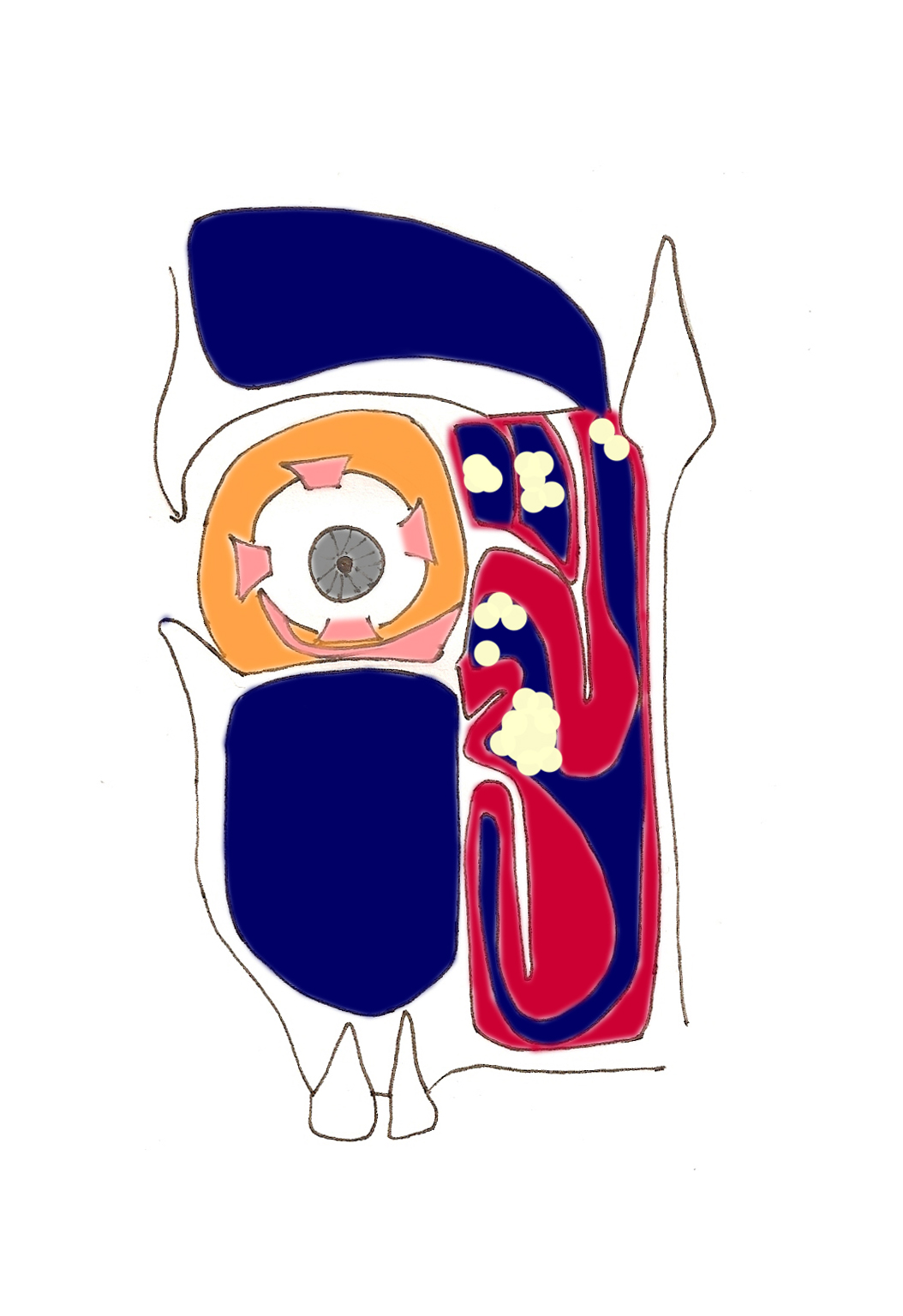 polypose2-nasale-sinus-obstruction-nez-bouche