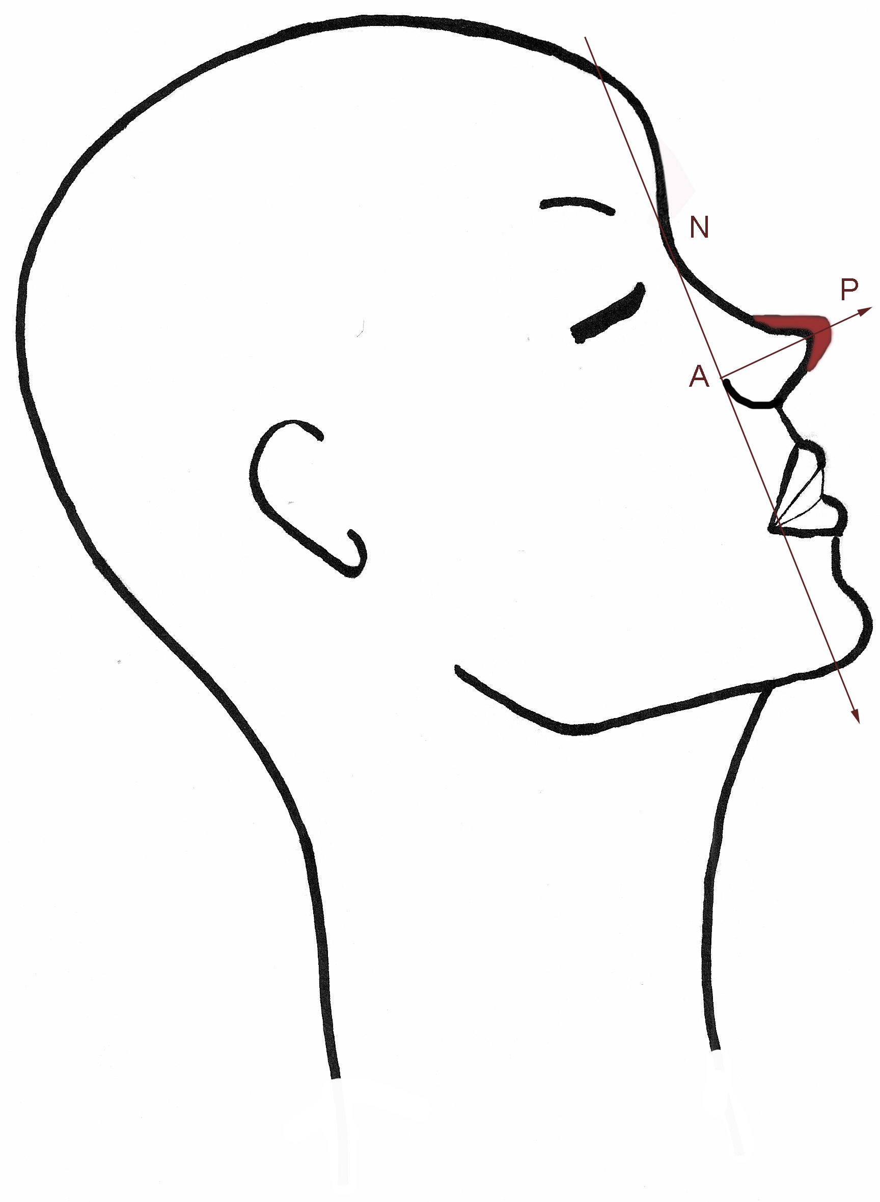 projection-pointe-nez-rhinoplastie-chirurgie-esthetique