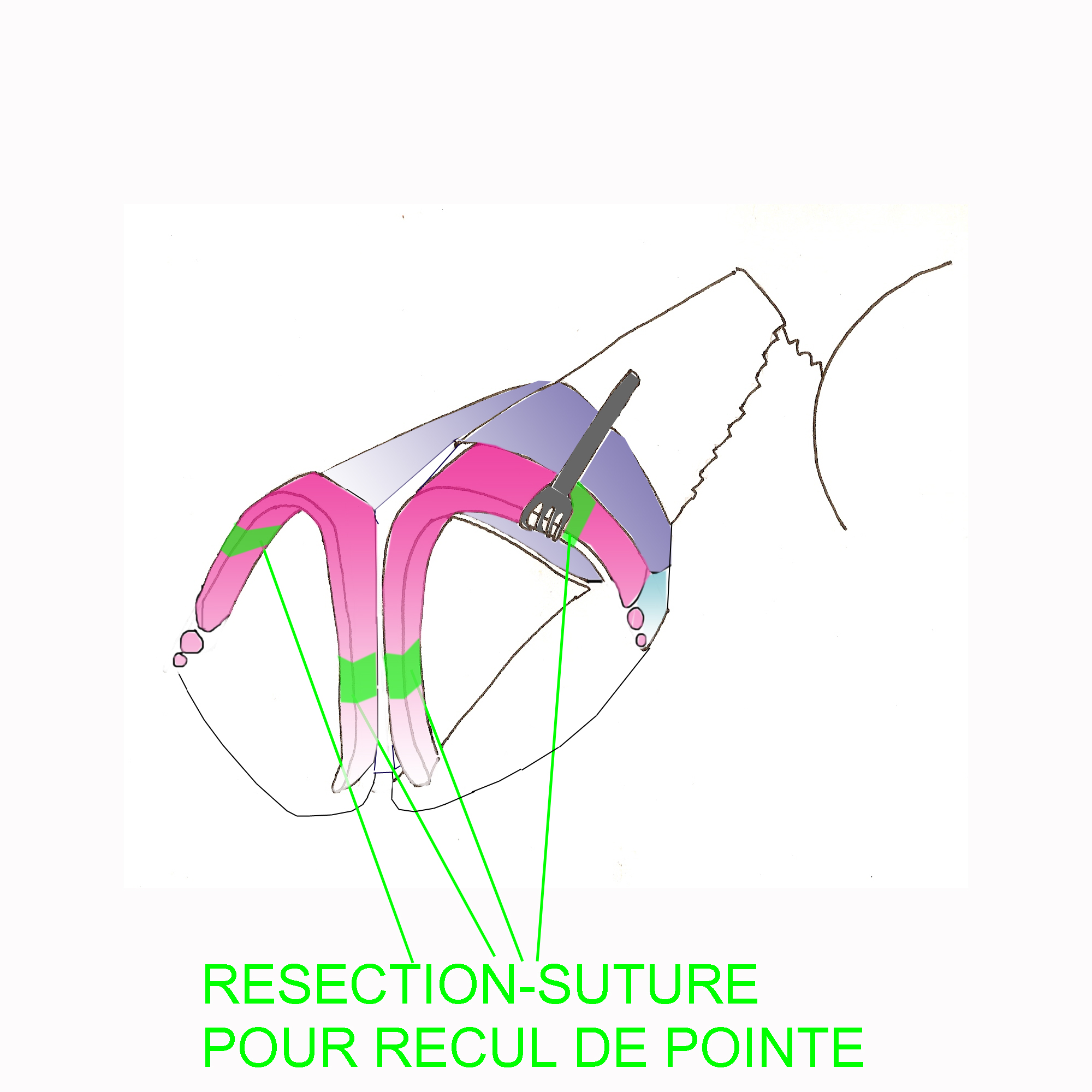 recul-pointe-nez-rhinoplastie-chirurgie-esthetique