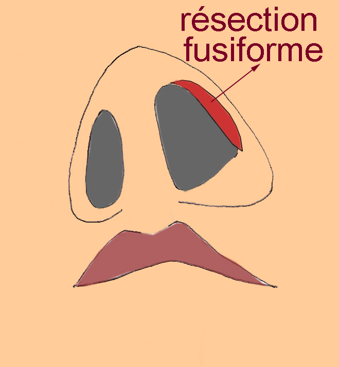 resection-aile-narine-pendante-chirurgie-esthetique-rhinoplastie