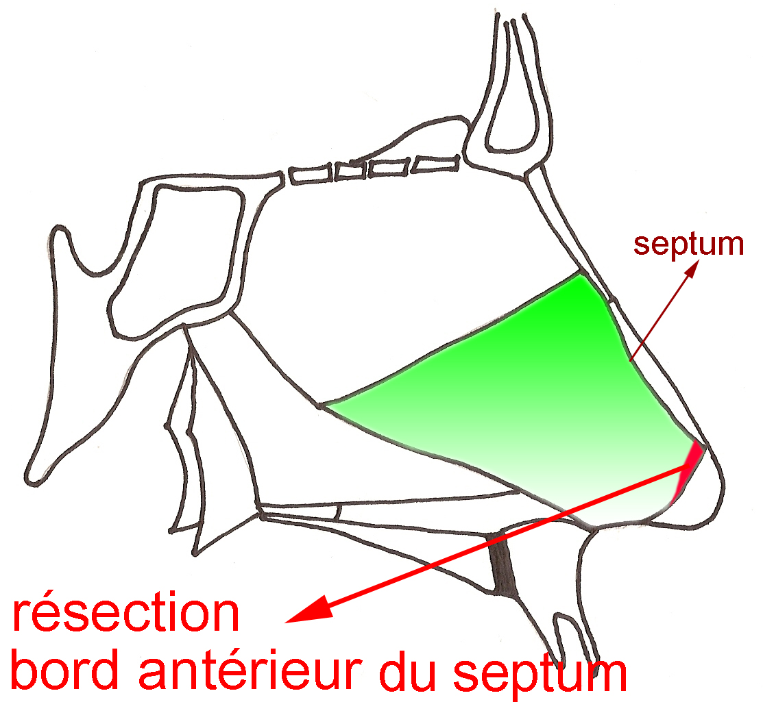 resection-bord-cloison-nasale-septum-chirurgie-esthetique-rhinoplastie