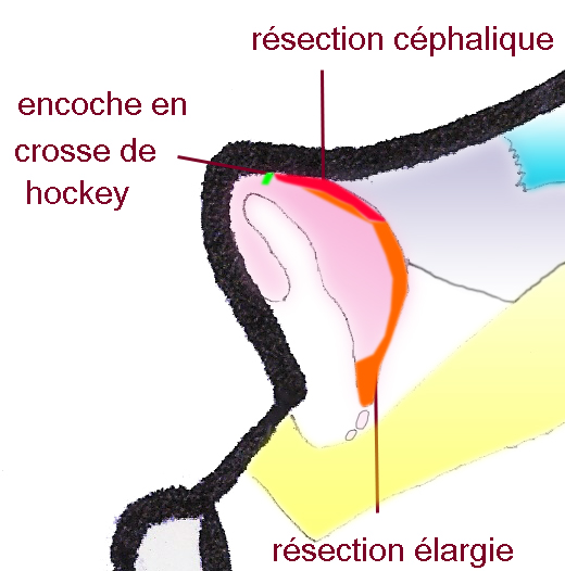 resection-cephalique-alaires-nez-gros-chirurgie-esthetique-rhinoplastie