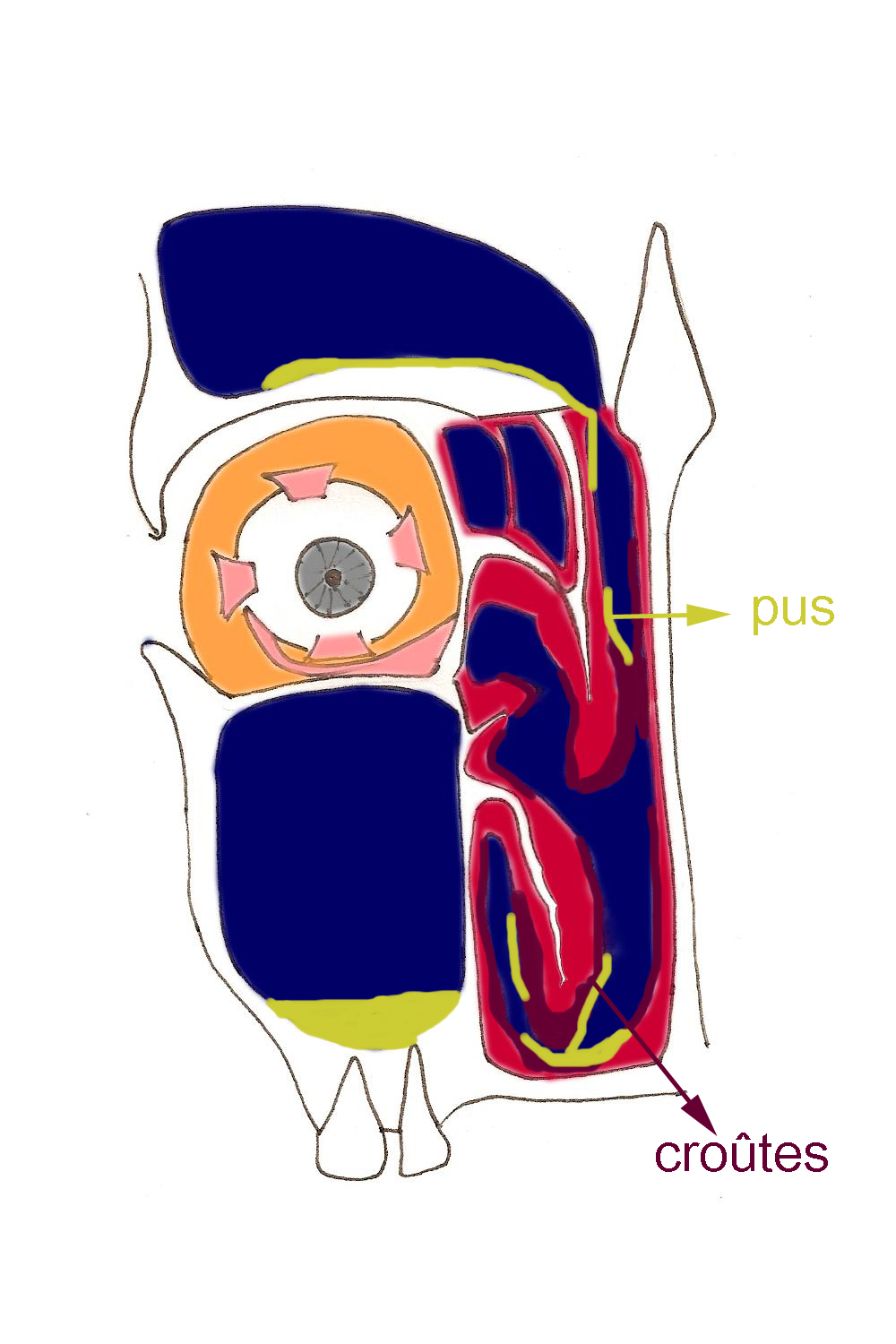 rhinosinusite-atrophique-sinus-infection-obstruction-nasale