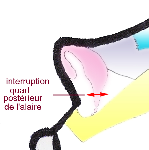 section-alaire-recul-pointe-nez-rhinoplastie-chirurgie-esthetique