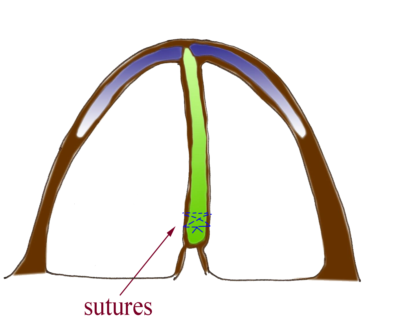 suture-cloison-redressee-chirurgie-esthetique
