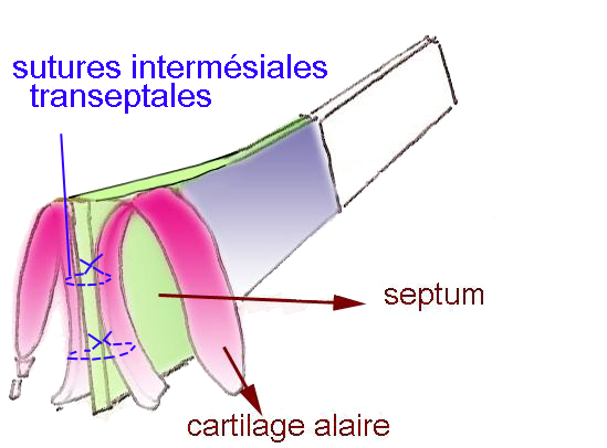 suture-intermesiale-chirurgie-esthetique